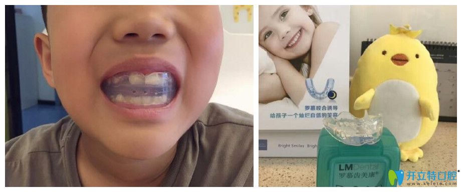 重慶牙齒矯正哪里好？茁悅口腔牙齒正畸案例效果來說明