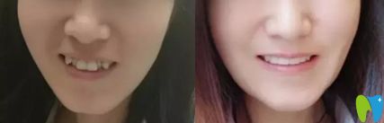 廣州圣貝隱形牙齒矯正前后對比圖