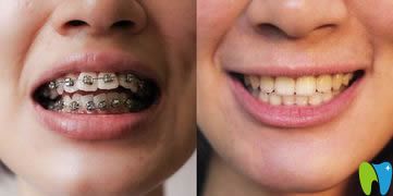 吳勇牙齒正畸案例效果對比圖