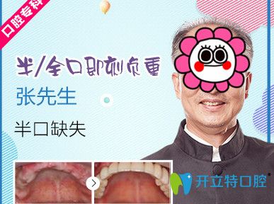 杭州美奧口腔半口牙即刻種植案例對比圖