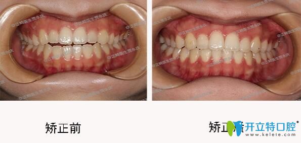 成都口腔哪里正畸好？圣貝口腔牙齒矯正效果來揭曉