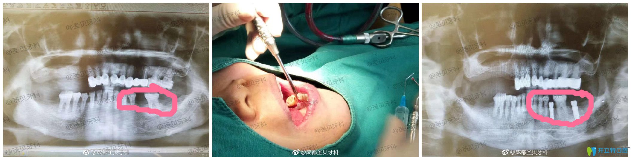 圣貝口腔種牙怎么樣？案例效果來驗證