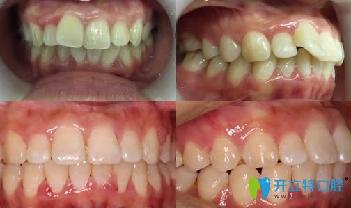 <!--<i data=20240703-sp></i>-->恒愿齒科黃曉莉牙齒矯正案例效果對比圖