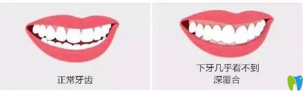 請(qǐng)問(wèn)牙齒深覆合是什么？詳解牙齒深覆合如何矯正
