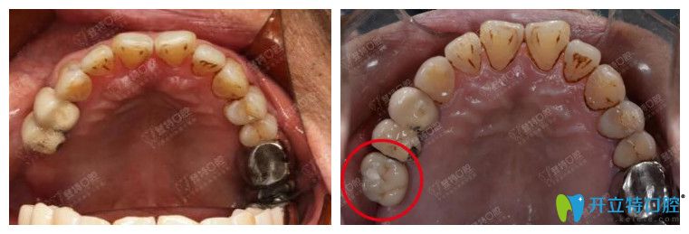 廈門(mén)登特口腔為60歲高血壓患者進(jìn)行種牙案例