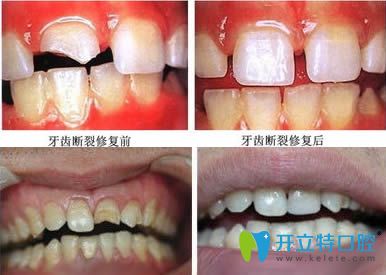<!--<i data=20240703-sp></i>-->恒愿齒科常紅琴牙體修復(fù)案例效果對比圖