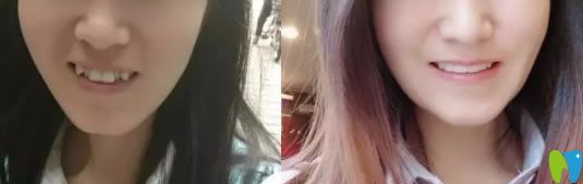 湛江致美口腔隱形牙齒矯正前后對(duì)比圖