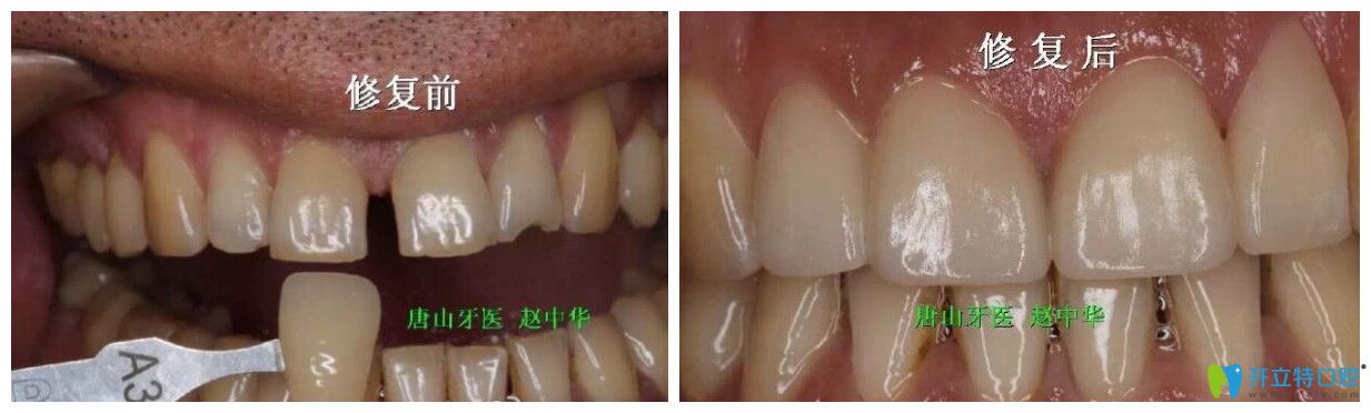 唐山趙中華微創(chuàng)瓷貼面修復(fù)牙齒案例