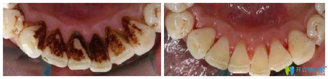 <!--<i data=20240703-sp></i>-->口腔超聲波洗牙前后對比圖