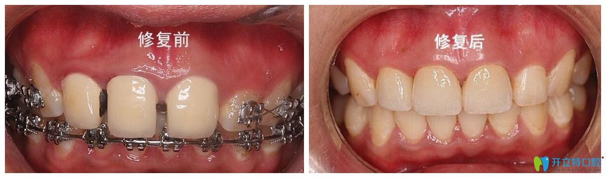 <!--<i data=20240703-sp></i>-->口腔趙中華牙齒修復(fù)案例