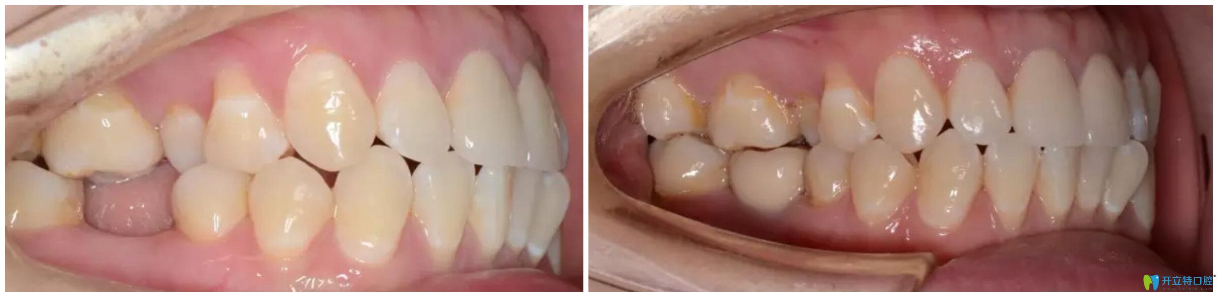 太原眾牙口腔3D無(wú)痛種植牙案例