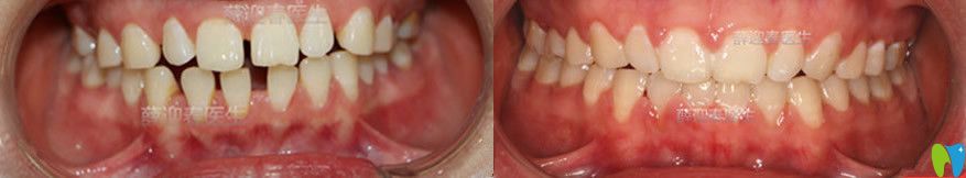 半隱形陶瓷矯正前后對(duì)比圖