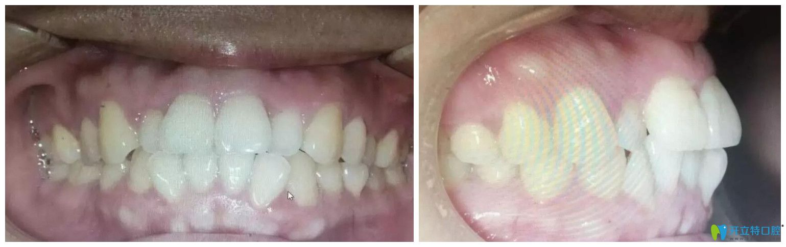 找趙中華做牙齒矯正前口腔正面、側(cè)面照