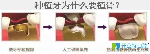 牙科醫(yī)生揭秘：種植牙為什么植骨及什么情況需要植骨種牙
