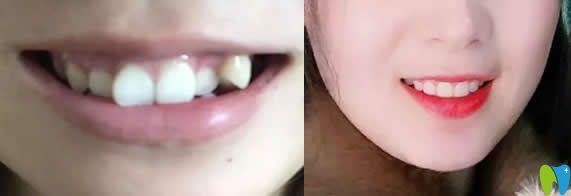 湛江致美口腔怎么樣?透露牙齒矯正和種植牙顧客的親身體會(huì)