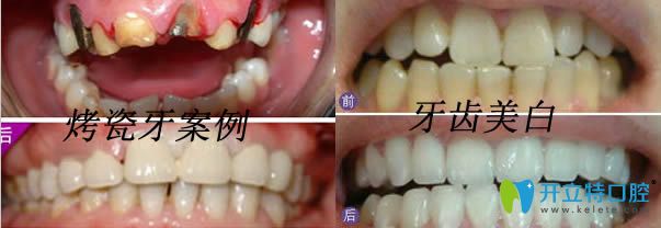 <!--<i data=20240703-sp></i>-->東奧口腔烤瓷牙和牙齒美白案例效果圖