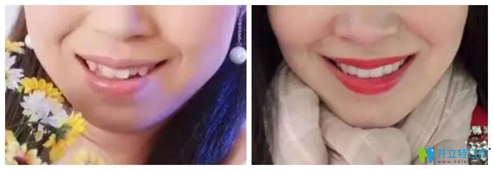 嘴突、牙齒亂 32歲在唐山北極星口腔做了金屬托槽矯正牙齒