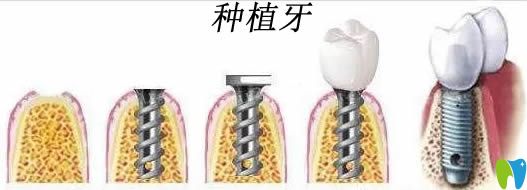 種植牙國(guó)產(chǎn)好還是進(jìn)口好?國(guó)產(chǎn)種植體和進(jìn)口種植體區(qū)別在哪