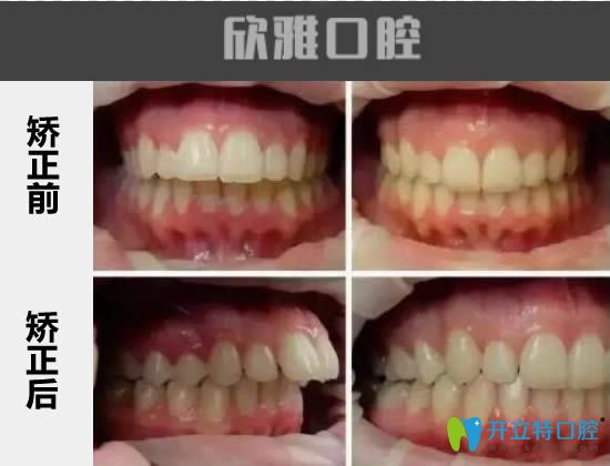 32歲顧客在長(zhǎng)春欣雅口腔做完齙牙矯正的對(duì)比效果
