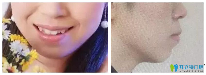 去<!--<i data=20240703-sp></i>-->口腔做牙齒矯正前正面、側(cè)面照