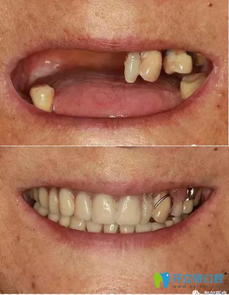 長(zhǎng)春欣雅口腔半口種植牙案例圖