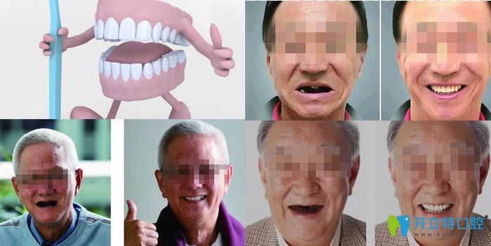 全口種植牙修復案例圖