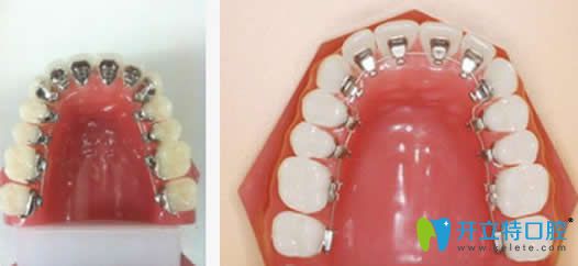 為什么很少人做舌側(cè)隱形矯正?舌側(cè)牙齒矯正的優(yōu)缺點了解下