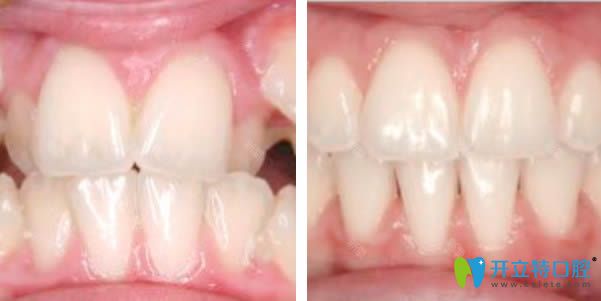 <!--<i data=20240703-sp></i>-->恒愿齒科黃鵬飛醫(yī)生牙齒矯正前后對(duì)比圖 <!--<i data=20240703-sp></i>-->恒愿齒科黃鵬飛醫(yī)生牙齒矯正前后對(duì)比圖