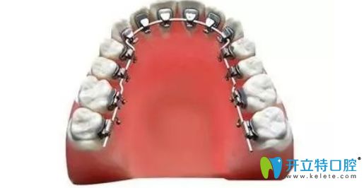 長春欣雅口腔閻華醫(yī)生科普舌側(cè)矯正適合哪種牙齒等疑問