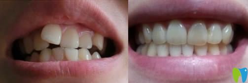 <!--<i data=20240703-sp></i>-->王富來(lái)醫(yī)生牙齒正畸效果對(duì)比圖