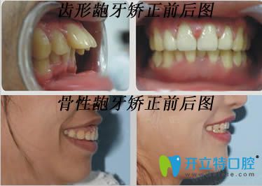 齙牙矯正矯正前后效果對(duì)比圖