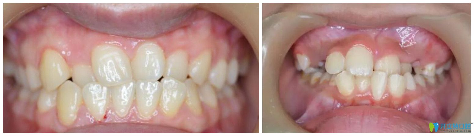 個(gè)別牙反合