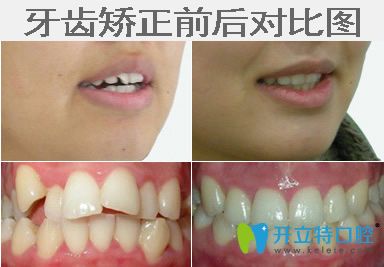 牙齒錯(cuò)亂矯正前后對比圖