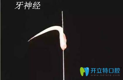 牙齒神經圖片