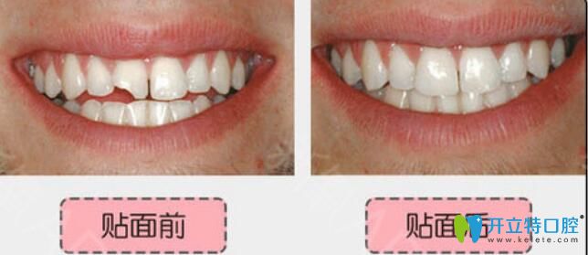 無錫北極星口腔楊亮亮怎么樣？真人案例及反饋來驗(yàn)證