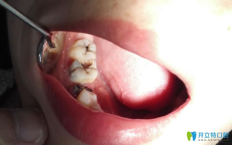 一個(gè)牙醫(yī)的良心忠告：小孩子蛀牙不僅要補(bǔ)，還要及時(shí)補(bǔ)