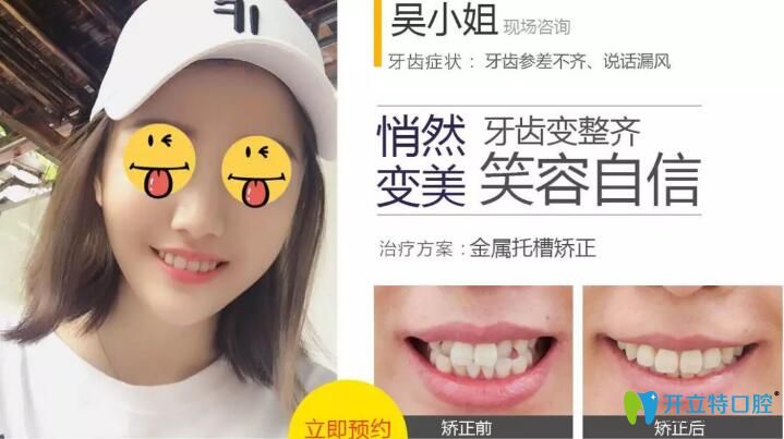 無(wú)錫北極星口腔金屬托槽矯正案例效果對(duì)比圖 無(wú)錫北極星口腔金屬托槽矯正案例效果對(duì)比圖