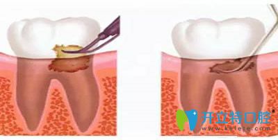 洗牙和齦下刮治可以一起做嗎？看洗牙和刮治的區(qū)別在哪里
