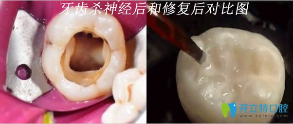 牙齒殺神經后和修復后的對比圖