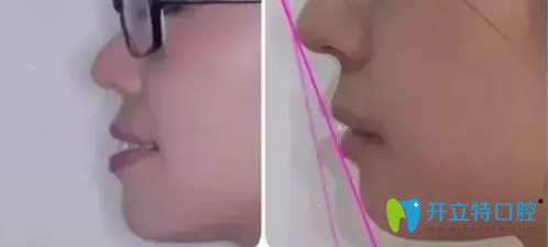 35歲顧客齙牙牙齒矯正案例對比圖