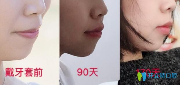 牙齒矯正能改變臉行嗎？看突嘴正畸170天臉型變化圖