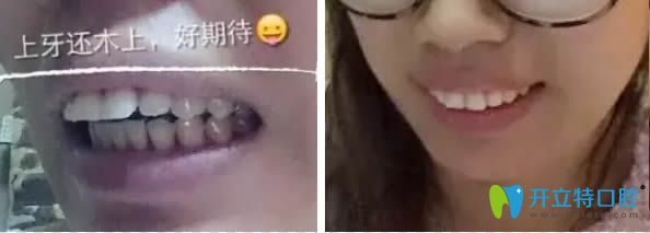 聽說長(zhǎng)春欣雅和拜博的價(jià)格不貴,就去欣雅口腔做了舌側(cè)矯正