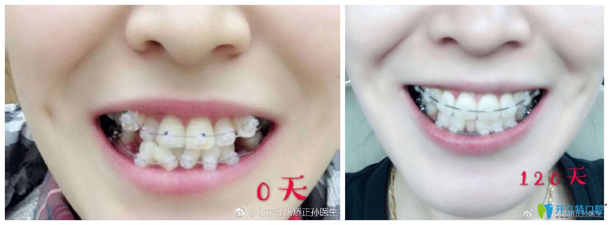 北京中諾口腔劉興華正畸怎么樣？案例效果來驗(yàn)證