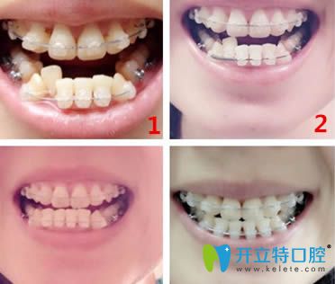 重慶牙博士口腔牙齒正畸案例圖