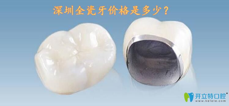 2025深圳全瓷牙價格表曝光!看完價格我驚呆了,竟然這么劃算