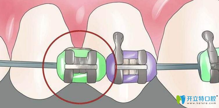 自鎖托槽矯正技術(shù)