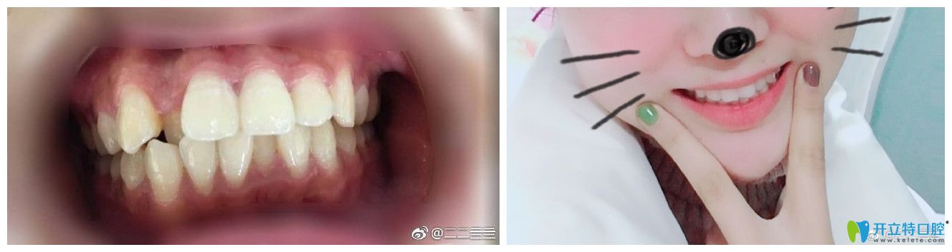 北京中諾口腔孫金鑫牙齒矯正好不好？案例效果來證明