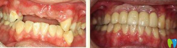 孫金鑫牙齒種植案例效果對比圖