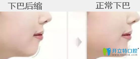 下巴后縮帶牙套有用嗎？真相揭秘下巴后縮矯正后堪比整容