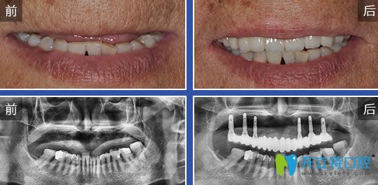 廣州圣貝口腔正規(guī)嗎?來聽一聽牙齒矯正種植牙顧客怎么評(píng)價(jià)